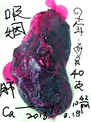 八成肺病患者是“黑肺”永远都不会褪色(图)