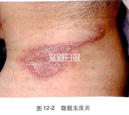 小心!夏天碰到这种虫子 千万不能拍死